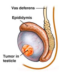 Life insurance after testicular cancer - a guide