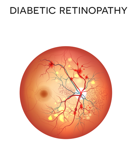 Life insurance with Type 1 Diabetes and Retinopathy